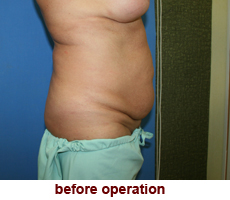 plastic-surgery-tummy-tuck